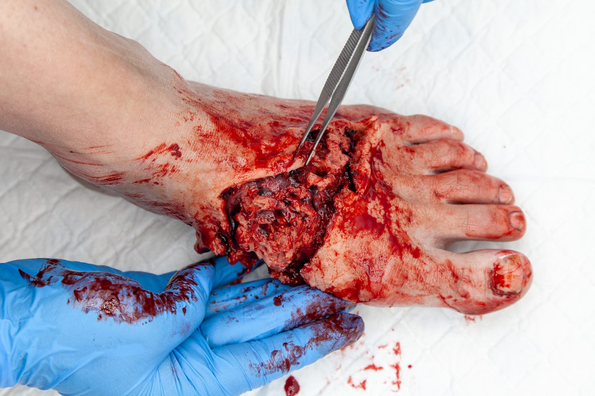 Foot crush and degloving moulage, clinical-grade silicone