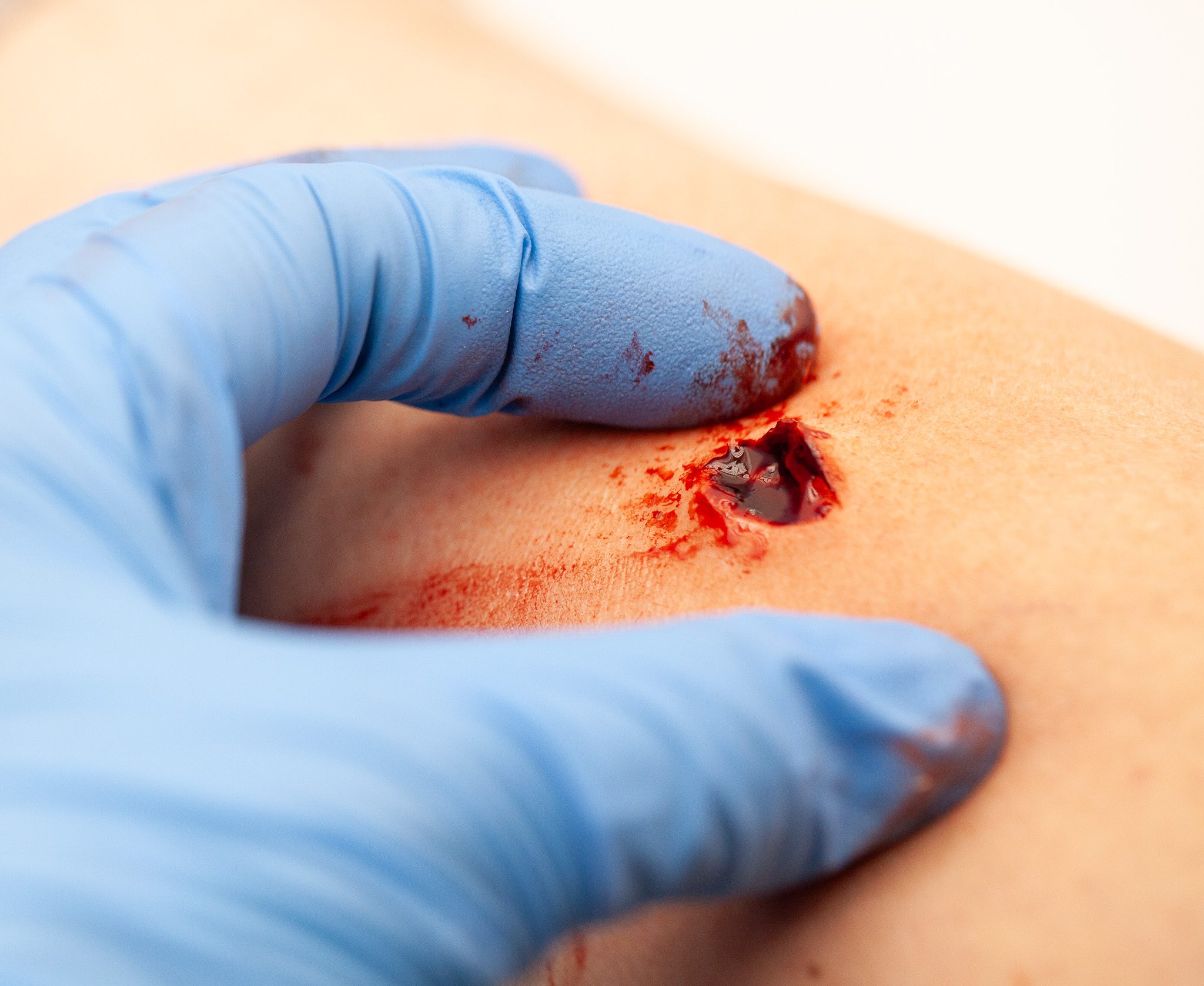 Gunshot entry wound moulage, clinical-grade silicone