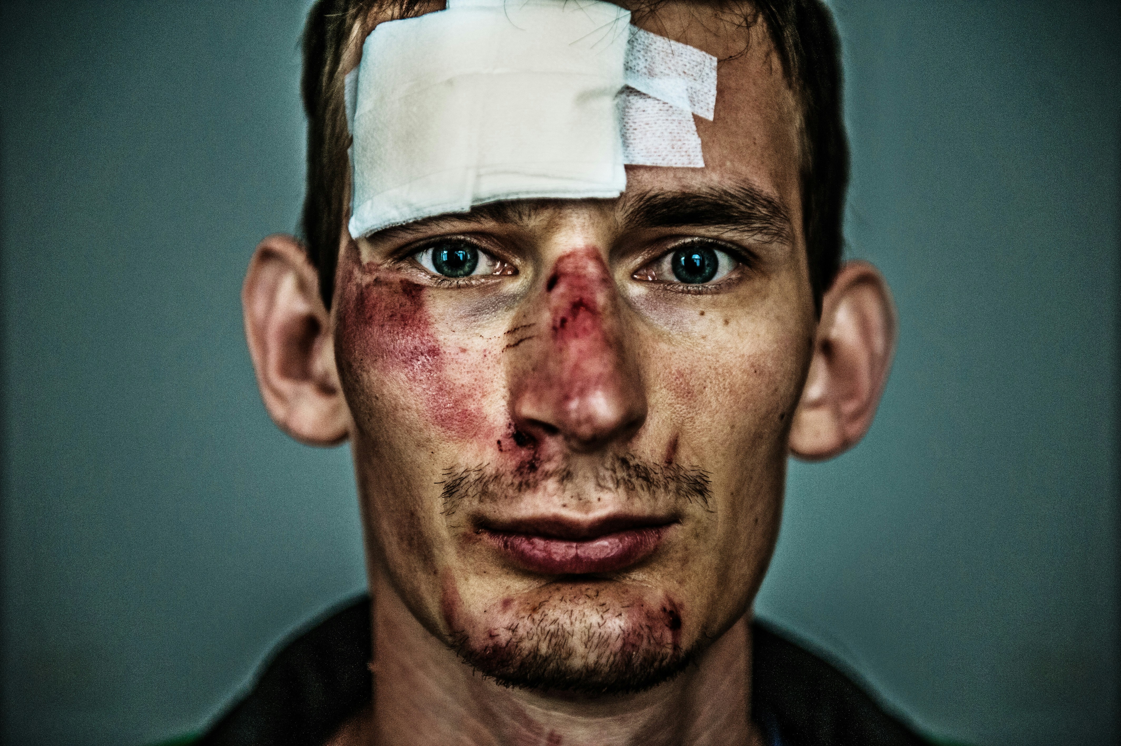 Moulage wound detail